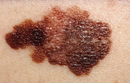 Malignud Melanoma