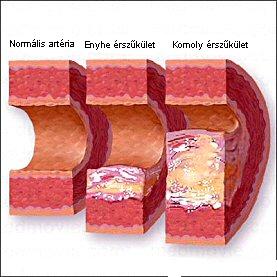 20071205_atherosclerosis1