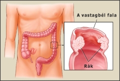 Vastagbélrák