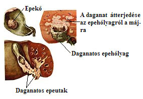 epeholyag daganat