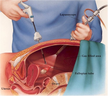 pneumoperitoneum